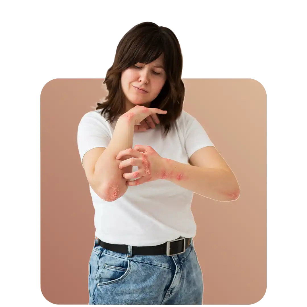 Psoriasis